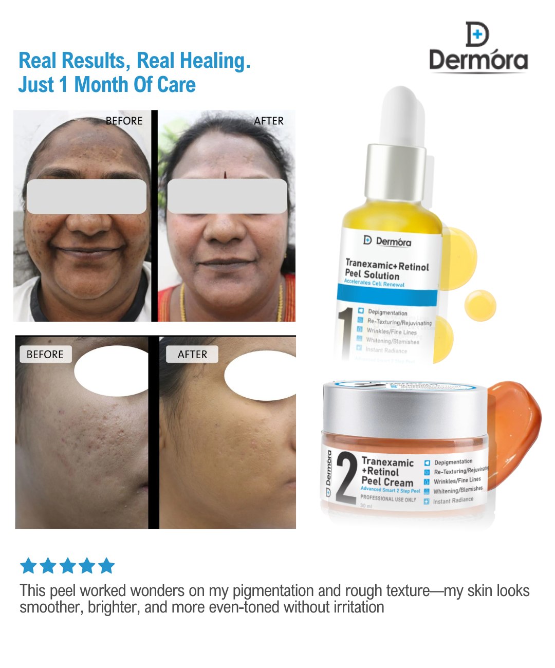 Dermora Professional 6% Medium Advanced 2-Step Tranexamic + Retinol Peel Kit With 5-Steps | Enzyme Cleanser Peel (12g) | Pre Peel Cleanser (100ml) | Tranexamic + Retinol Peel Solution (30ml) | Tranexamic + Retinol Peel Cream (30ml) | Post Peel Neutralizer (100ml)