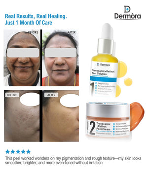 Dermora Professional 6% Medium Advanced 2-Step Tranexamic + Retinol Peel Kit With 5-Steps | Enzyme Cleanser Peel (12g) | Pre Peel Cleanser (100ml) | Tranexamic + Retinol Peel Solution (30ml) | Tranexamic + Retinol Peel Cream (30ml) | Post Peel Neutralizer (100ml)
